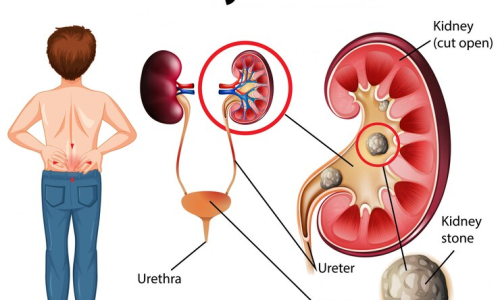 Kidney Stones